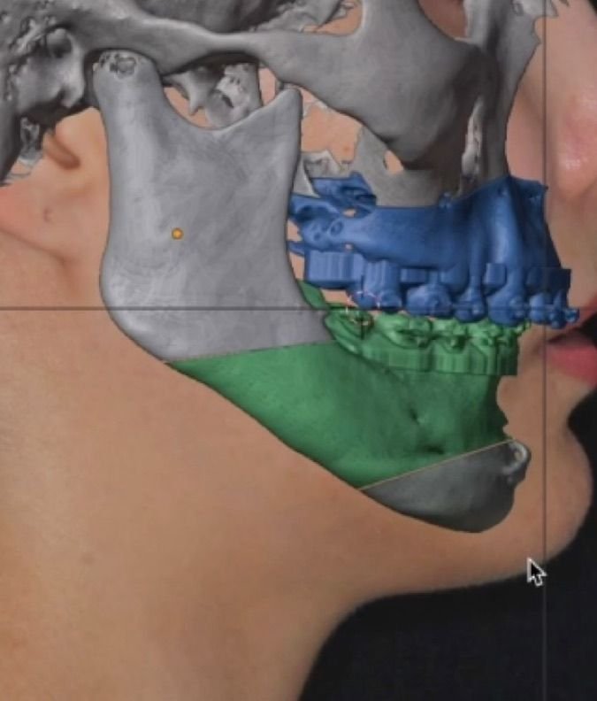 Render 3D de planeación quirúrgica de mandíbula