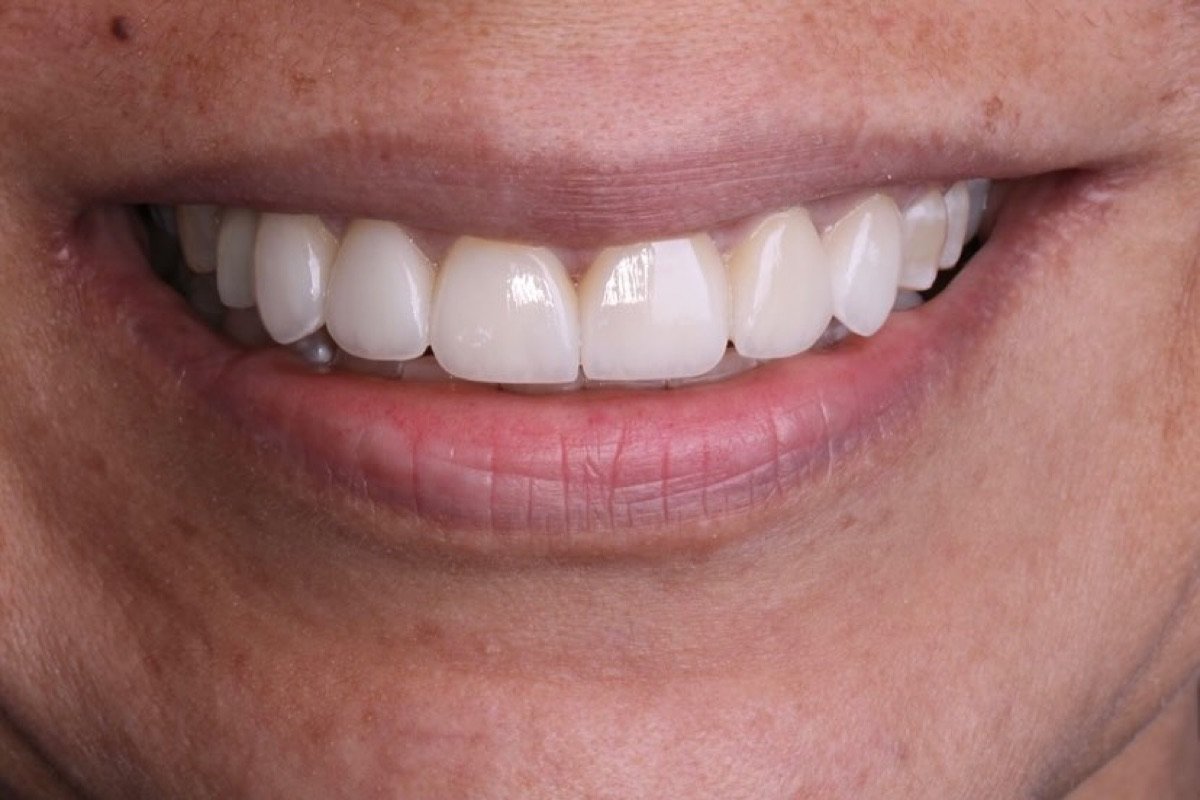 Sonrisa terminada